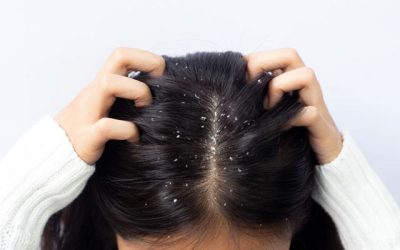 6 Simple Home Remedies To Get Rid Of Dandruff!