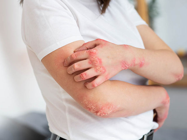 Fungal Skin Infections: How To Treat Them?