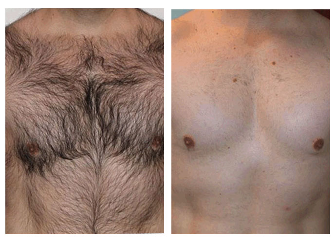 Hair removal clearance surgery